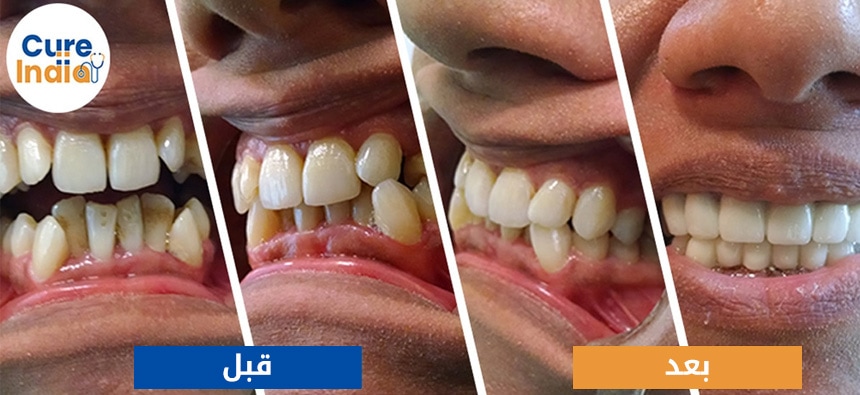 تلبيس الأسنان قبل وبعد الصور